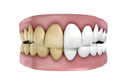 Blanqueamiento dental antes y despu&eacute;s