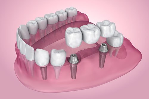 Implantolog&iacute;a Dental